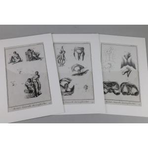 Hermaphrodites. Trois Planches Originales De l'Encyclopédie De Diderot Et d'Alembert.